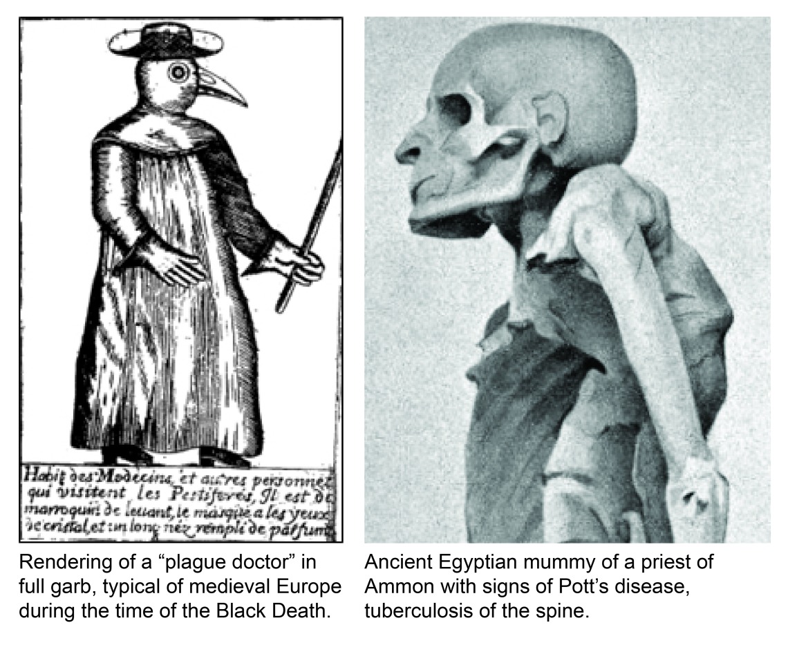A montage of two images: a plague doctor and an Egyptian mummy showing evidence of Pott's Disease