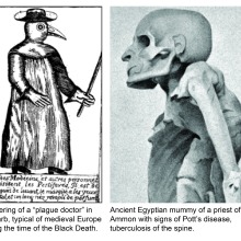 A montage of two images: a plague doctor and an Egyptian mummy showing evidence of Pott's Disease